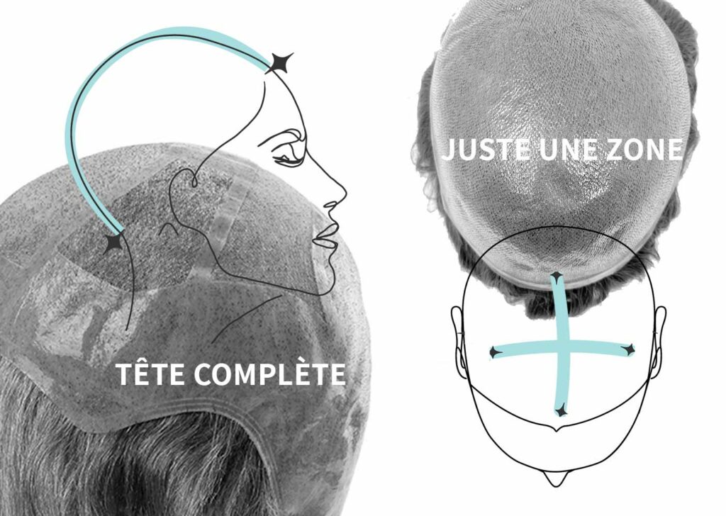 prothese_capillaire_ou_perruque_difference perruque ou prothèse capillaire